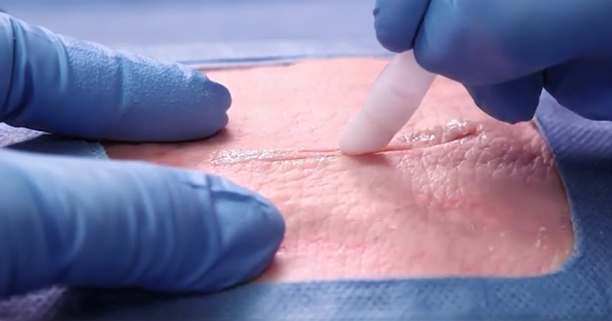 Surgical glue being applied to a closed joint replacement incision, the glue side of the staples vs glue comparison